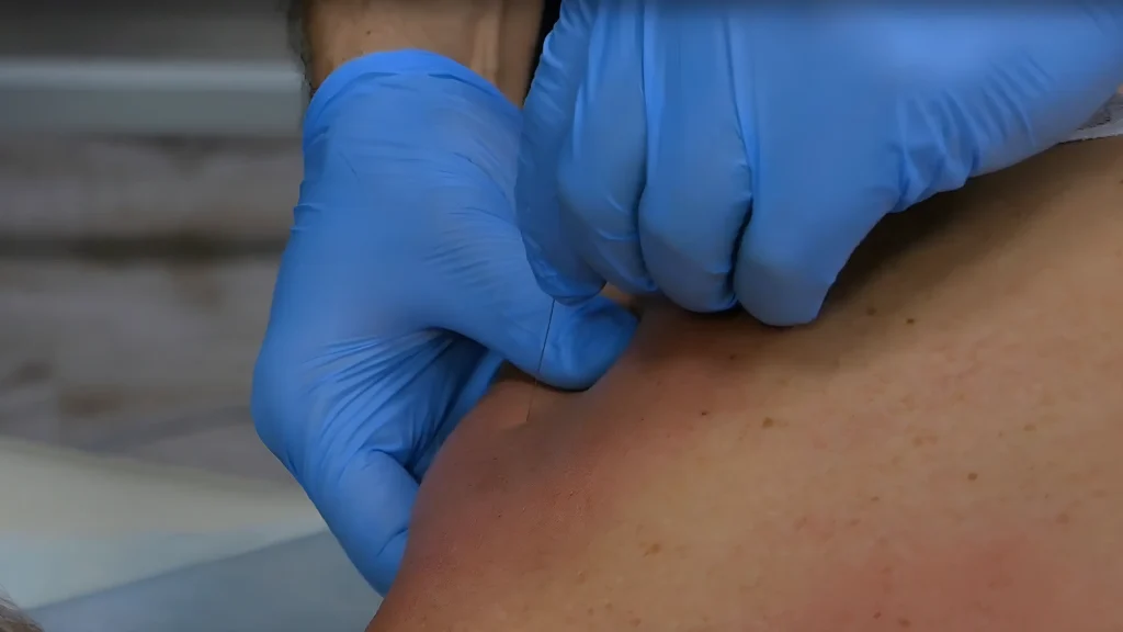 suhie igly obuchenie massazh guasha obuchenie