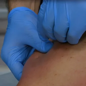 Массаж Гуаша и метод сухой иглы при боли в шее