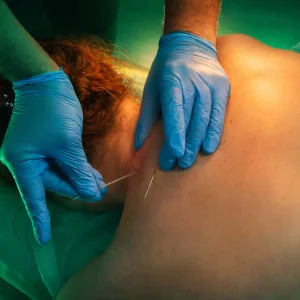 Акупунктурный лифтинг обучение